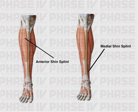 Shin Splints Phase Iv