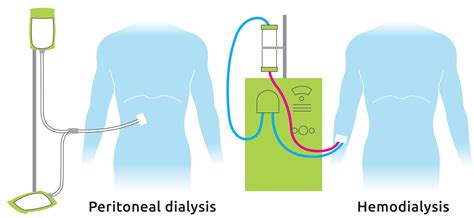 What Are The Dialysis Options Transplant Living