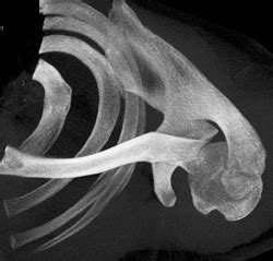 Acromion Fracture - Musculoskeletal Case Studies - CTisus ...