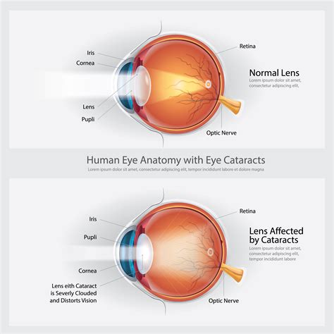 Cataracts Vision Disorder And Normal Eye Vision Anatomy Vector