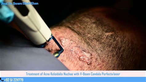 Acne Keloidlis Nuchae Treatment With V Beam Candela Perfecta Laser By Prof Dr Ikram Ullah Khan