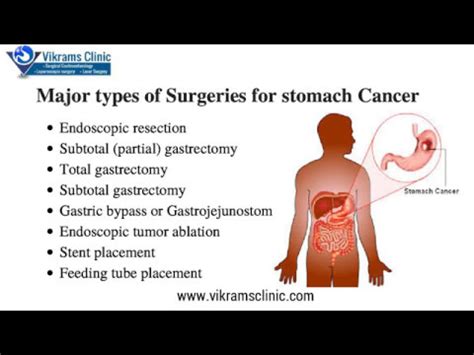 Or, the cause may be a different medical condition that is not cancer. Stomach Cancer Treatment | Gastric Cancer Treatment ...