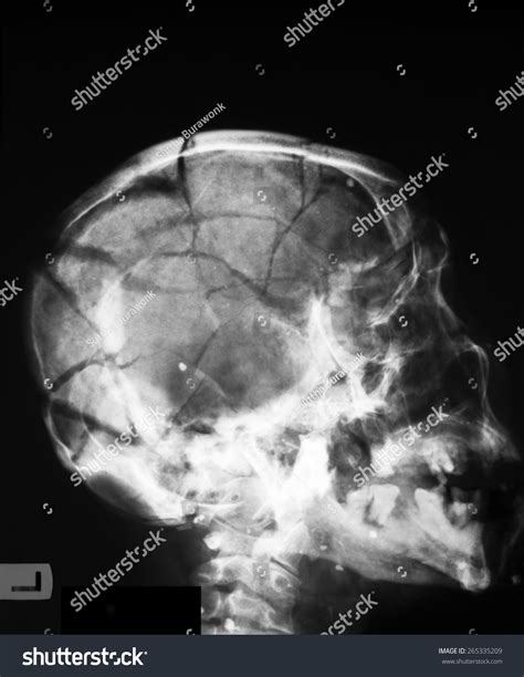 2320 Skull Fracture X Rays Images Stock Photos And Vectors Shutterstock