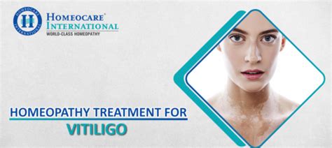 Homeopathy Treatment For Vitiligo Homeocare International