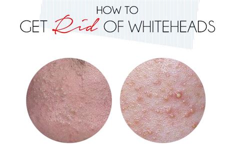 Skin Care 101 How To Get Rid Of Whiteheads Whiteheads How To Get