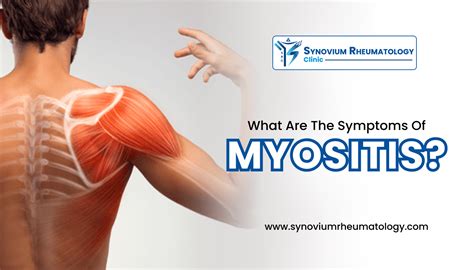 What Are The Symptoms Of Myositis Synovium Rheumatology