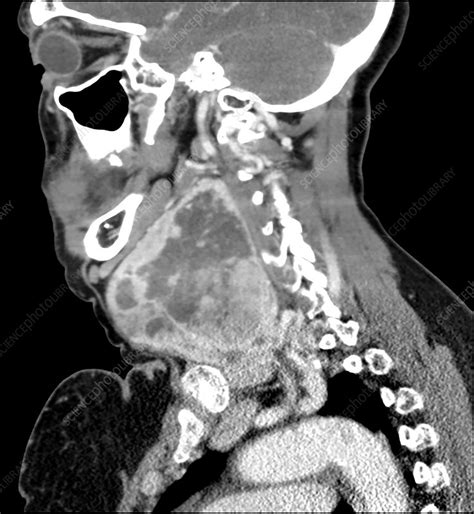 Large Thyroid Goiter Ct Stock Image C0365229 Science Photo Library
