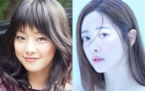 Plastic Surgery Before And After Korean Actress