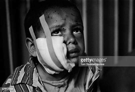 Shrapnel Wounds On The Face Of A Frightened Boy In A Ward At Sarajevo