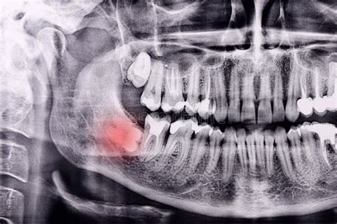 Horizontal Inflamed Wisdom Tooth On Panoramic Dental Tooth X Ray