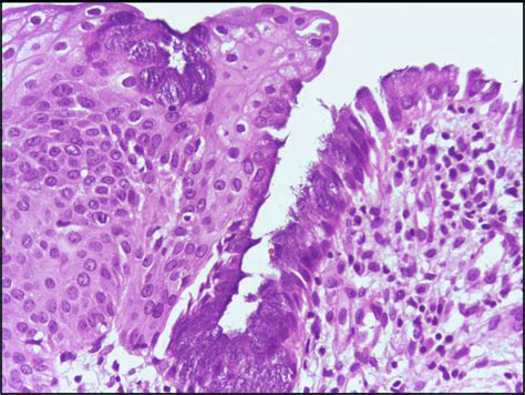 Squamous Metaplasia Of Uterine Cervix