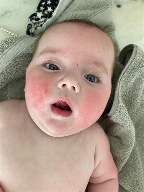Are Red Cheeks A Sign Of Teething