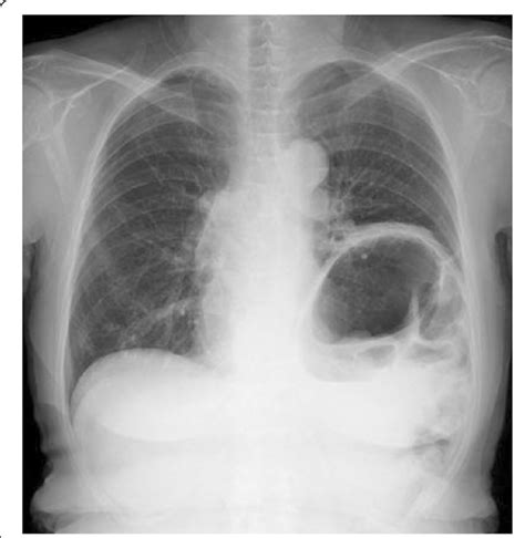 Chest X Ray Before Diaphragm Plication The Left Diaphragm Was Elevated