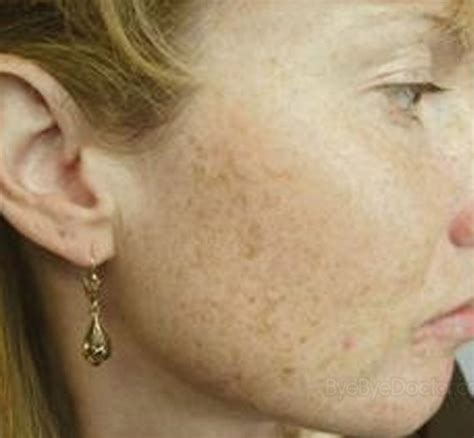 Brown Spots On Face Pictures Causes Prevention