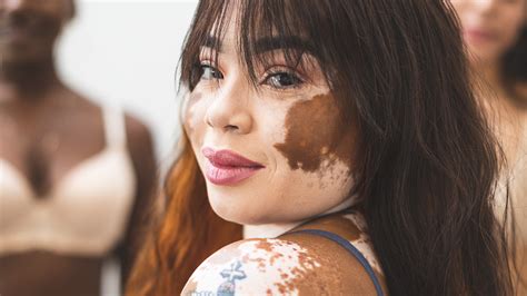 Vitiligo Treatments Is There A Cure Goodrx