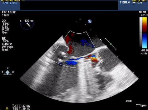 Reversible Mitral Regurgitation As A Complication Of Impella® 5 0 Video 2  On Imgur