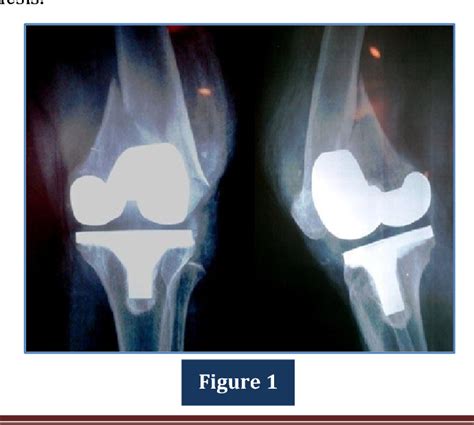 Figure 1 From Management Of Periprosthetic Distal Femoral Fracture