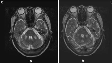 Mri Of The Patient An Axial T2 Weghted Image Revealed High Signal
