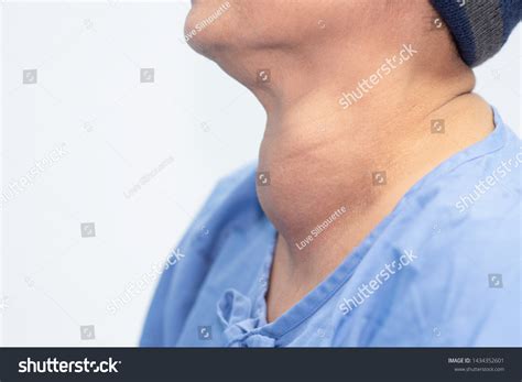 Enlarged Multinodular Thyroid Goiter Middleaged Asian Stock Photo