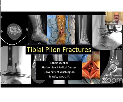 Tibial Pilon Fractures Bipmd