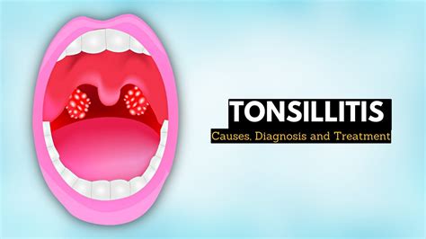 Tonsillitis Causes Signs And Symptoms Diagnosis And Treatment Youtube