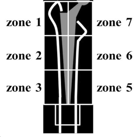 Gruens Zone Classification Download Scientific Diagram