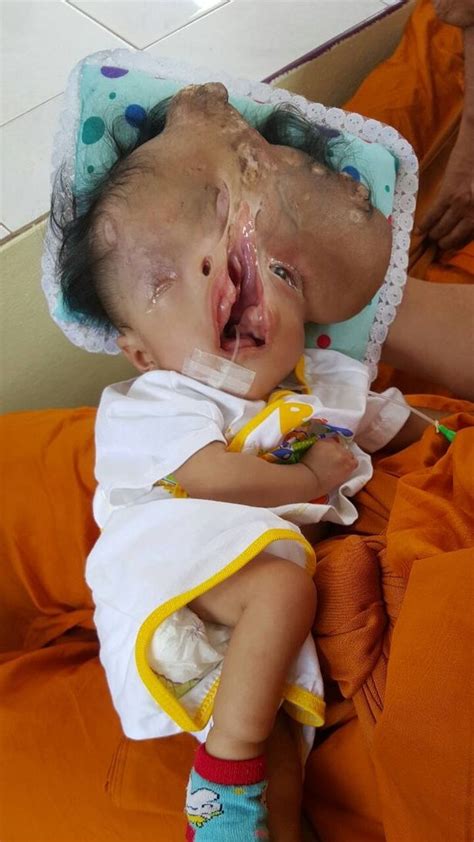 Baby Born Without A Skull And Half A Face Is Cared For By