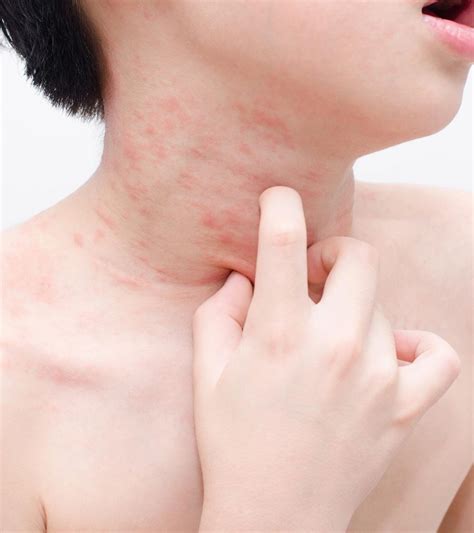 Skin Rashes On Children S Face Printable Templates Protal