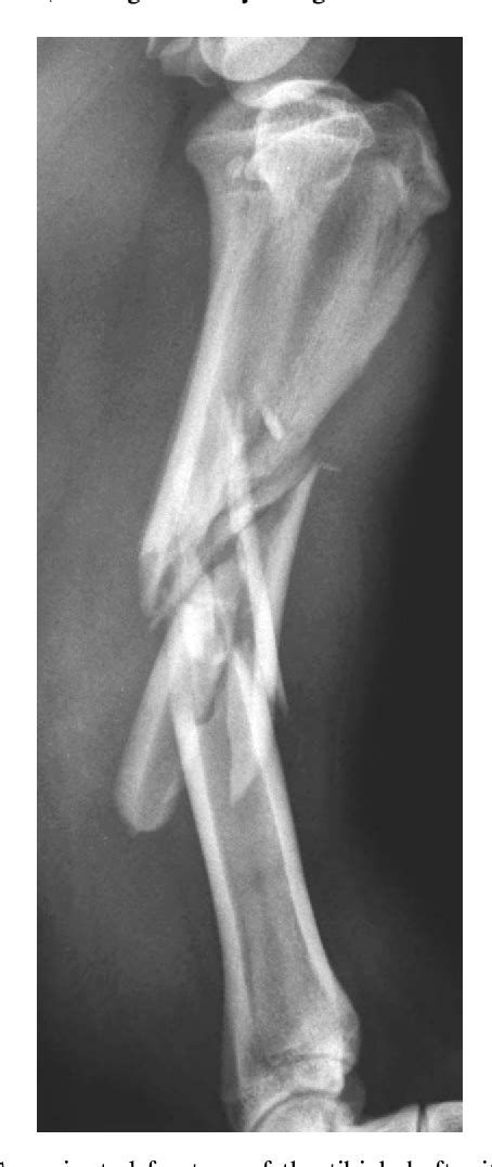Figure 1 From Treatment Of Comminuted Tibial Shaft Fractures In Four