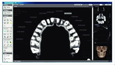 Cbct Image With An Axial View Of The Maxillary Jaw After Removal Of