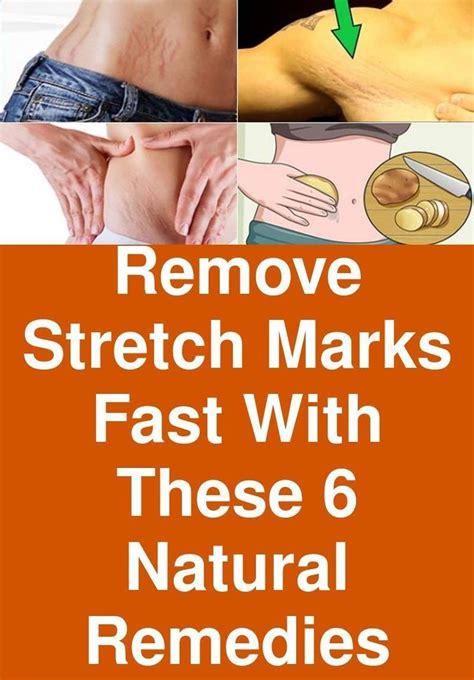 Remove Stretch Marks Fast With These 6 Natural Remedies Stretch Mark