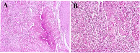 Malignant Squamous Cell Carcinoma Arising From The Epidermal Cyst A