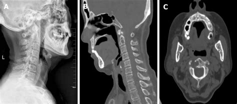 Solitary Bone Plasmacytoma Of The Upper Cervical Spine A Case Report