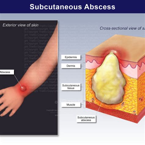 subcutaneous abscess trialexhibits inc