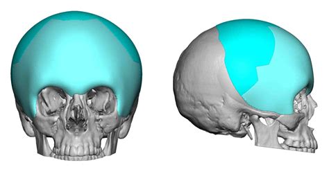 Large Custom Skull Implant For Fronto Temporal Augmentation Design Dr