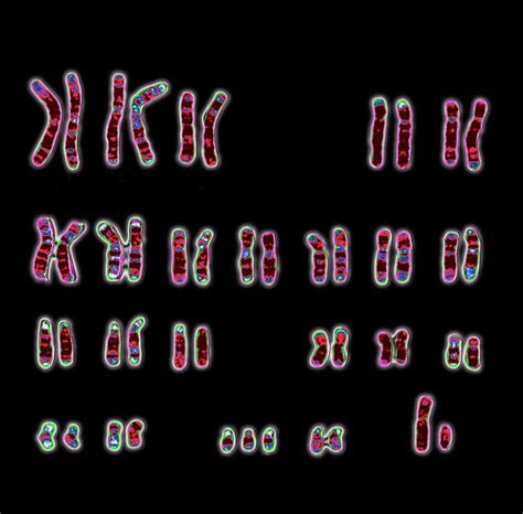 Karyotype Down Syndrome Male Captions Todays