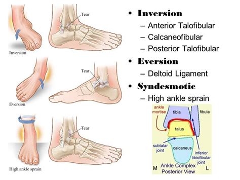 Of the lateral ankle ligament complex the most frequently damaged. Ankle Sprain | Sprained ankle, Ligament injury, High ankle ...