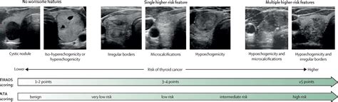 Diagnosis Of Thyroid Nodules The Lancet Diabetes And Endocrinology