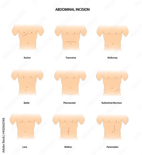 Abdominal Incision Different Types Of Abdominal Incision Surgery