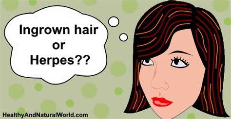 Ingrown Hair Vs Herpes Find The Differences Including Treatments
