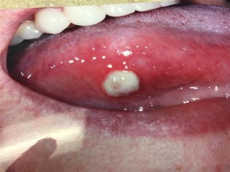 Mouth Cancer Bumps Under Tongue