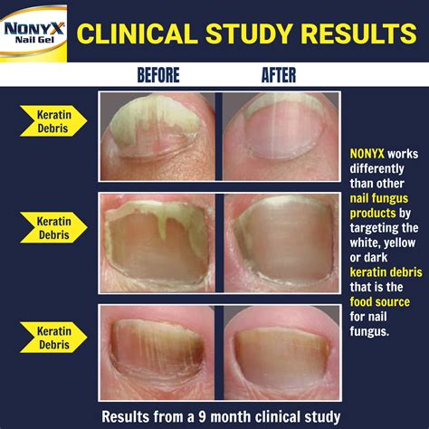 Mua Nonyx Fungal Nail Clarifying Gel A Toenail Fungus Treatment That