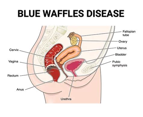 Is Blue Waffles Disease Real What A Gynecologist Thinks Century