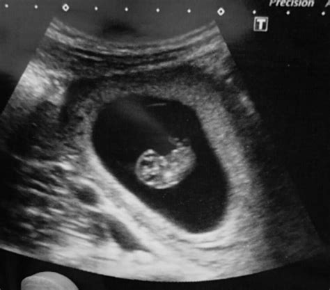 Ultrasound Scans At 8 Weeks Pics Netmums Chat