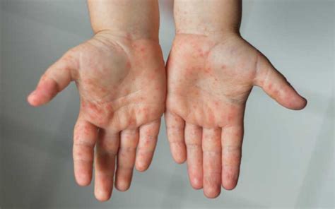 You may be having a condition called hand foot and mouth disease. Hand Foot And Mouth Disease (HFMD) - BabyTalk - Baby ...
