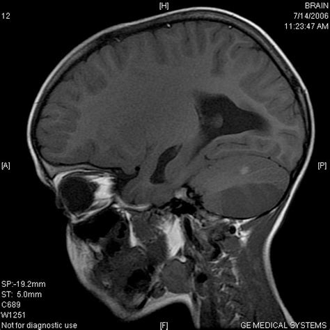 Bilateral Cerebellar Infarcts In A Child Eurorad