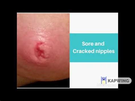 Sore Cracked Nipples And Inverted Or Flat Nipples IAP Breastfeeding App YouTube