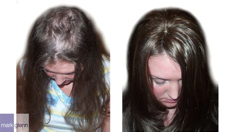 trichotillomania or compulsive hair pulling before and after london hair integration