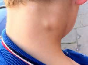 Dijete Ima Povećane Limfne čvorove U Vratu Uzroke I Liječenje