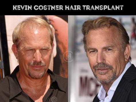 Kevin Costner Hair Transplant Hair Loss And Technical Analysis
